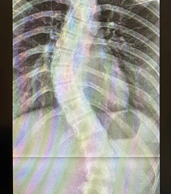 Scoliosis - Orthopaedics SA