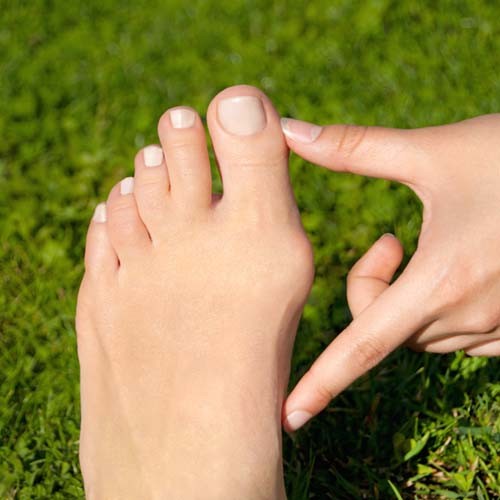 Bunions - Orthopaedics SA